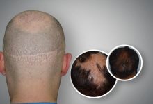 fut hair restoration surgery