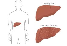 Best Liver Hospitals in Istanbul