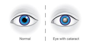 Cataract - Featured Image