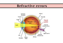 Refractive Errors - Featured Image