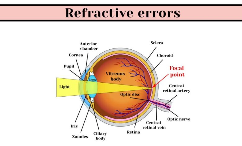 Refractive Errors - Featured Image