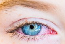 Conjunctivitis - Featured Image