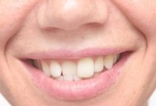 dental bonding crooked teeth